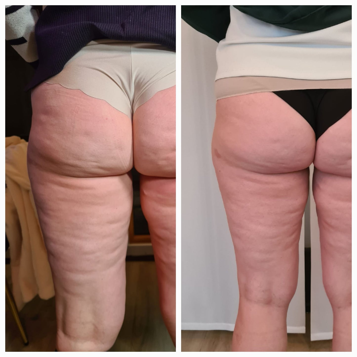 Rollon Beauty Gerät, Anti Cellulite Anwendungen - Straffung und Festigung des Bindegewebes
