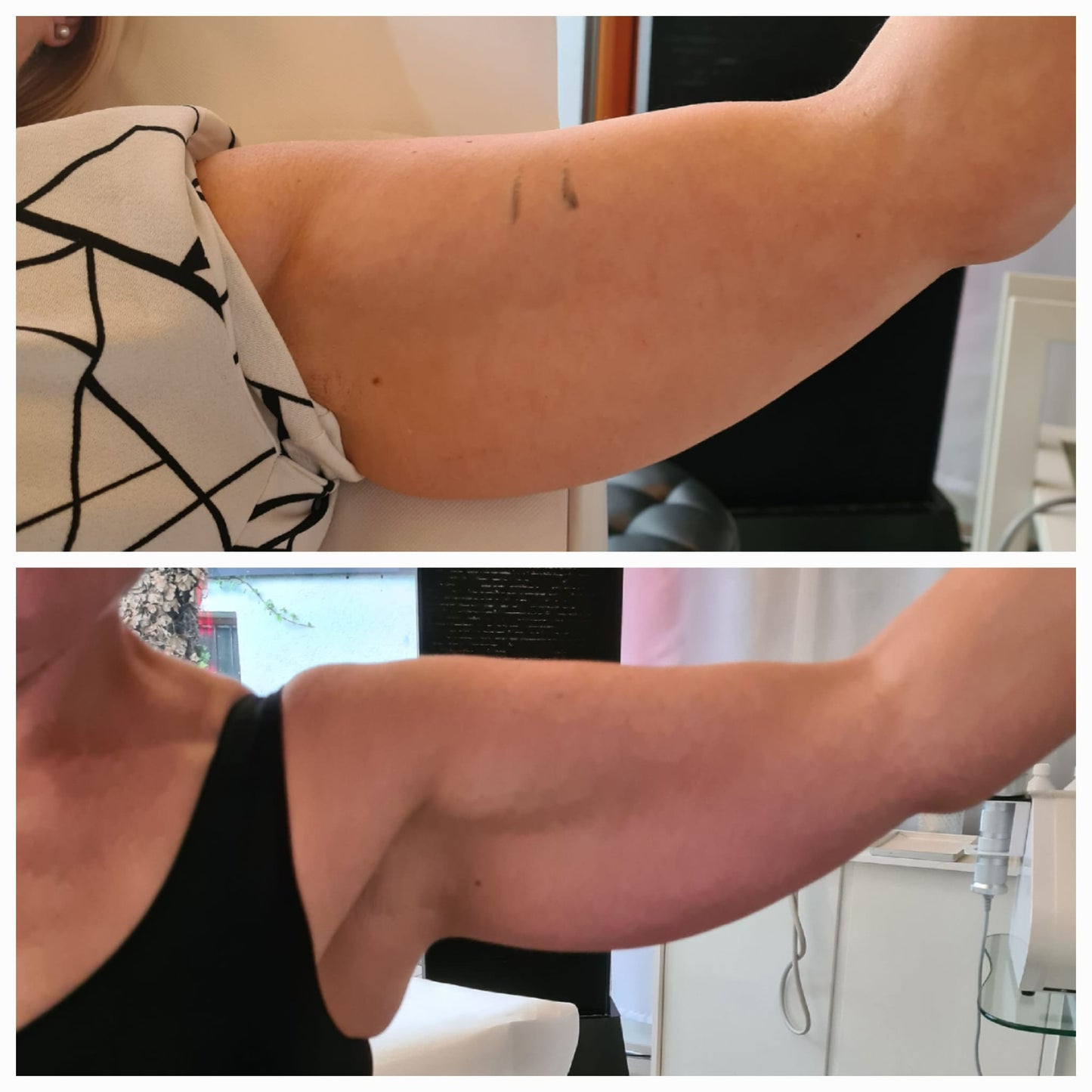 Rollon Beauty Gerät, Anti Cellulite Anwendungen - Straffung und Festigung des Bindegewebes