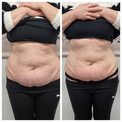 FS-8 Bodyforming Gerät | Kosmetisches System zur Haut- & Gewebestimulation | Inkl. Schulung