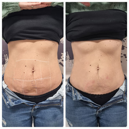 FS-8 Bodyforming Gerät | Kosmetisches System zur Haut- & Gewebestimulation | Inkl. Schulung